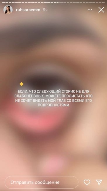 Узбекская блогерша Рухсора Эм уснула с макияжем и повредила себе глаз