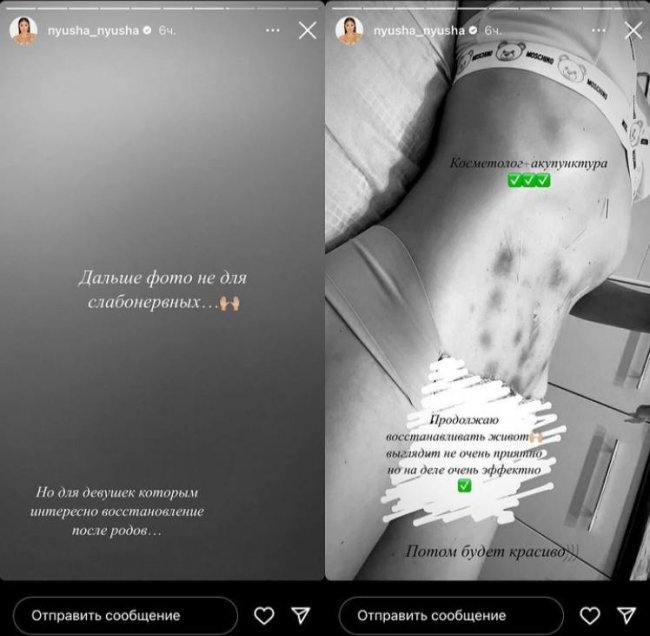 Нюша показала живот после беременности и ужаснула поклонников